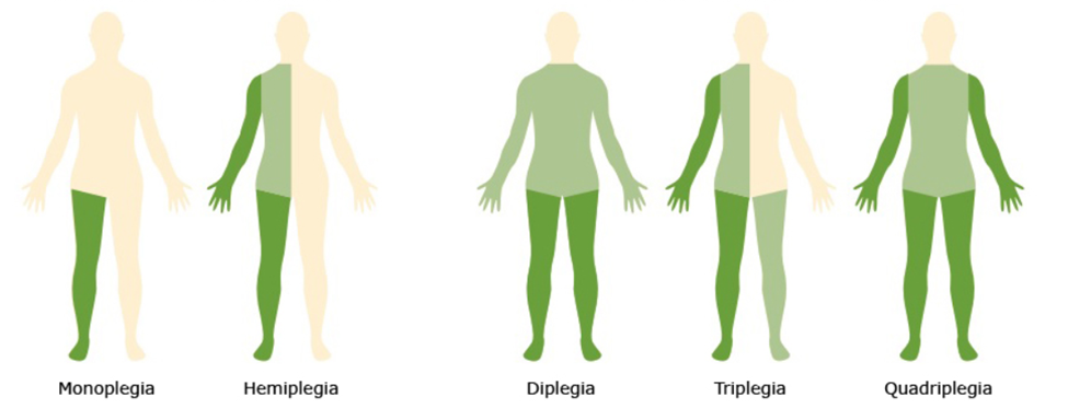 Tipos de paralisia cerebral
